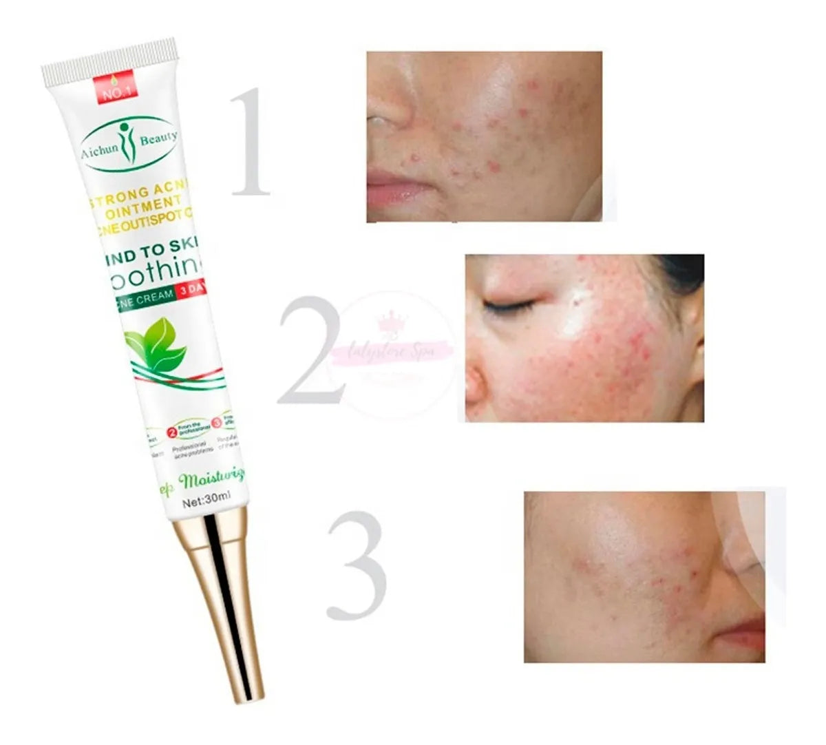 🌿 Aichun Beauty – Crema Facial Antiacné & Hidratante con Ácido Hialurónico 🌿